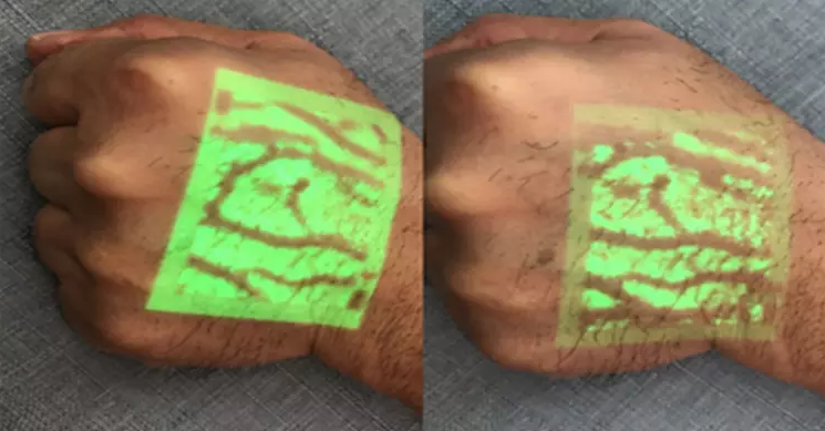 portable vein viewer 