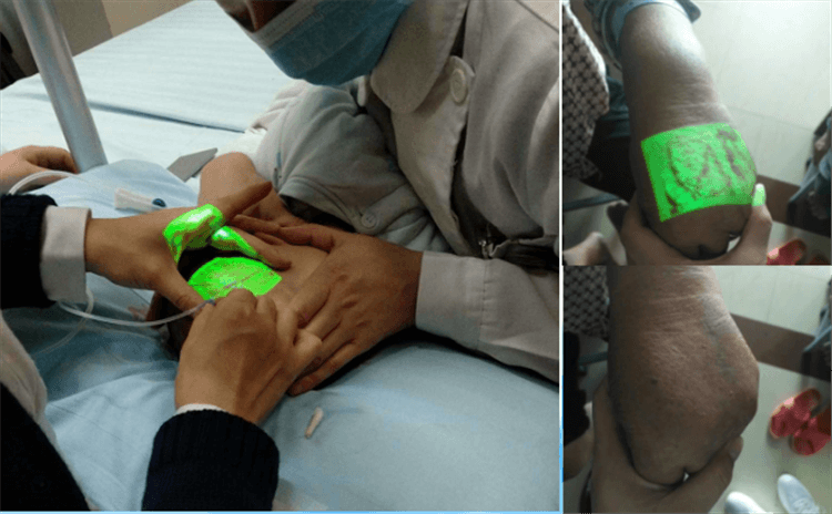 vein finder assisted Newborn and coronary heart disease