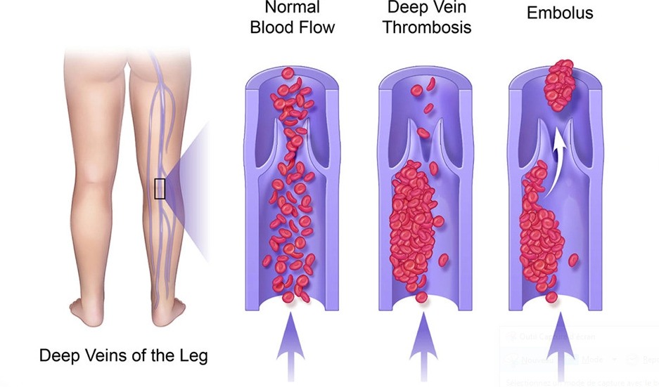 血栓静脈炎の診断