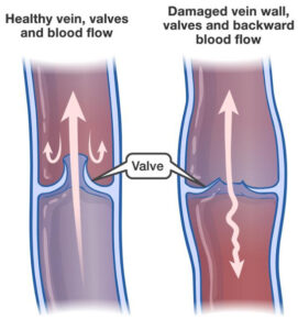 Vein Finding and Post-Phlebitic Syndrome - SIFVEINFINDER